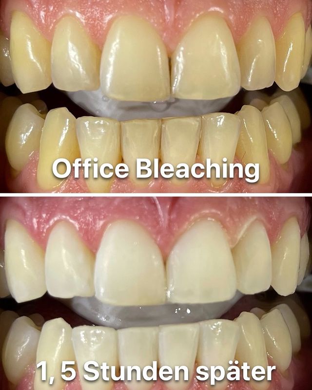 Patientenglück Zahnbleaching